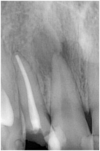福田1　右上1 歯髄壊死　◎